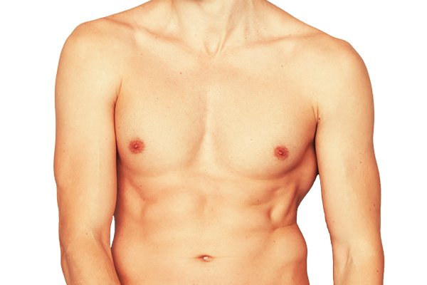 gynecomastia